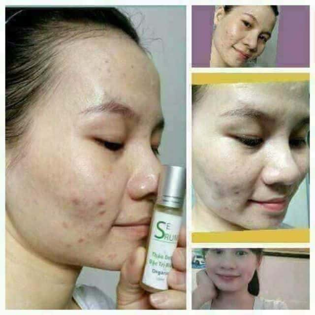 Cách sử dụng serum đặc trị mụn Trần Mao